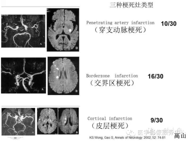 为什么会得腔隙性脑梗死包括为什么会得腔隙性脑梗的详细情况