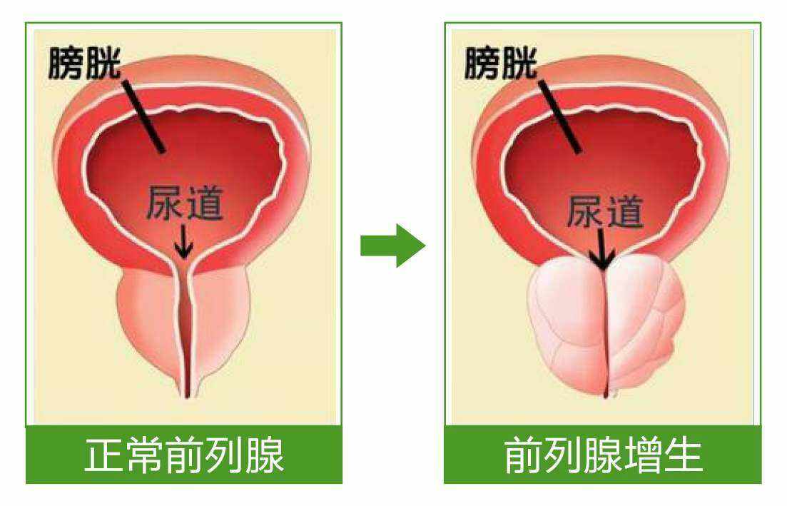 前列腺增生如何自愈补肾以及前列腺增生如何自愈的情况分析