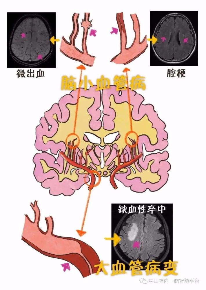 急性脑梗一般多久恢复正常以及脑梗一般多久恢复正常的情况分析