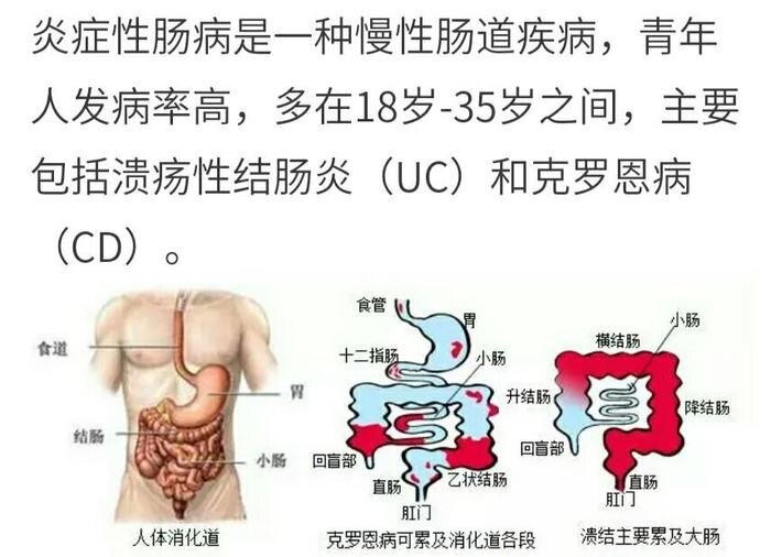 结肠炎有哪些症状表现，关于结肠炎有哪些症状详细情况