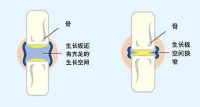 如何判断骨骺线是否闭合看腿，关于如何判断骨骺线是否闭合详细情况