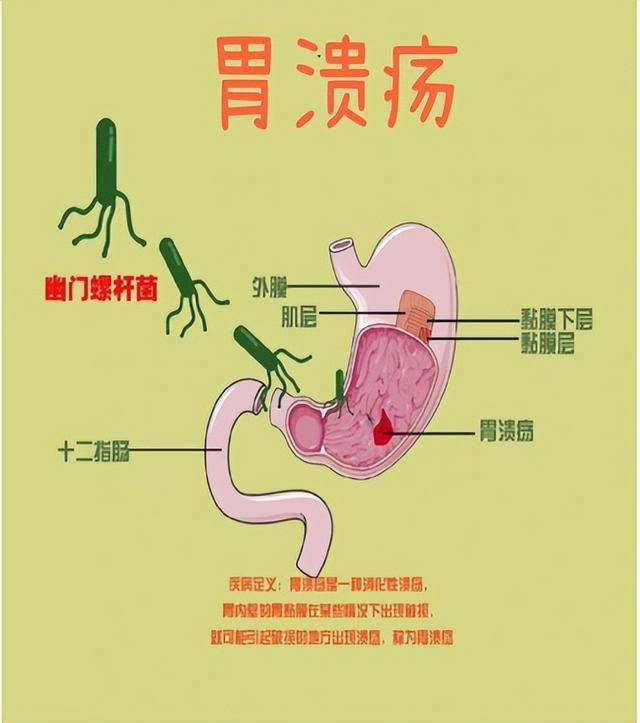 胃溃疡注意什么饮食禁忌有关胃溃疡饮食注意什么的详细内容