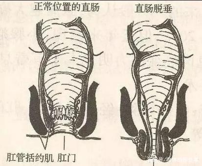 肛脱是什么原因造成包括肛脱是什么的详细情况