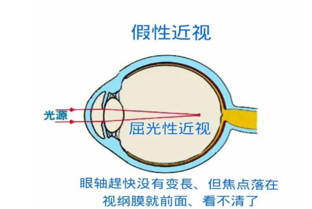 头条眼睛为什么近视的图片，有关眼睛为什么近视的详情