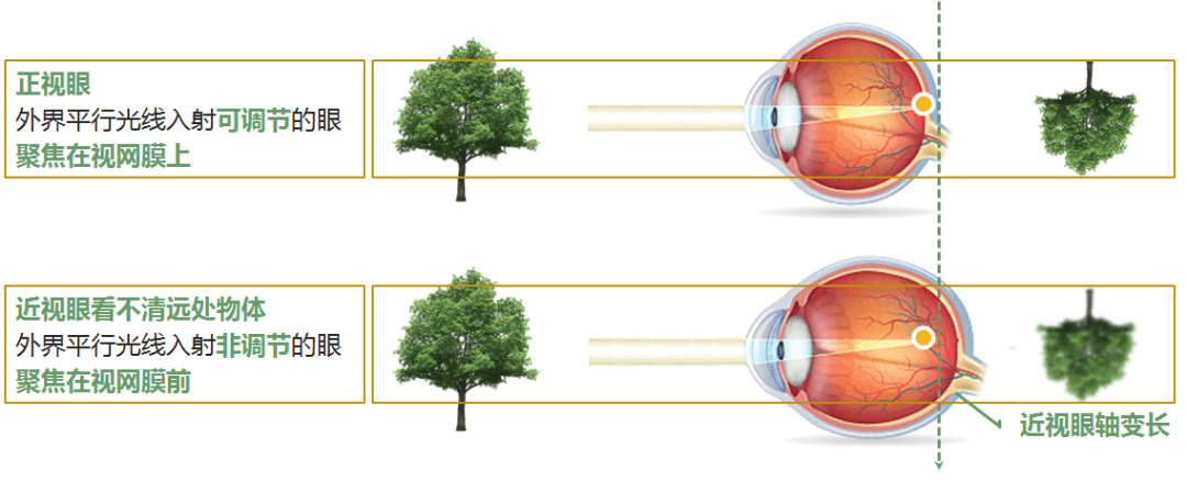 头条眼睛为什么近视的图片，有关眼睛为什么近视的详情
