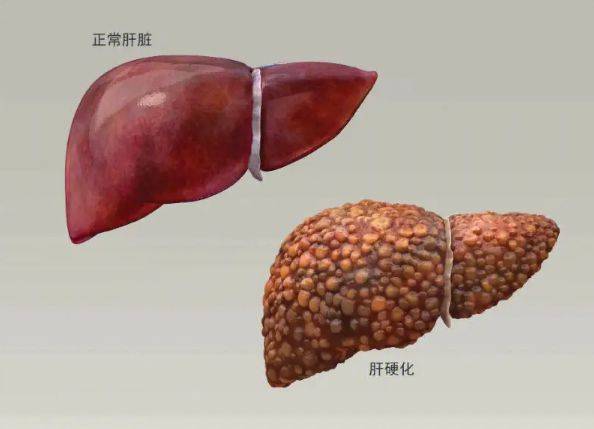 乙肝导致的肝硬化能活多久与肝硬化能活多久的原因