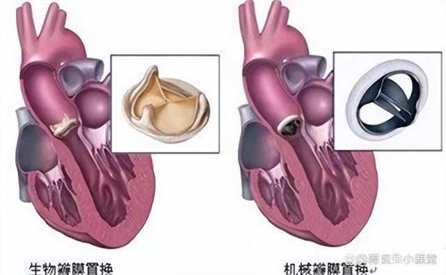 分享二尖瓣返流会自愈吗，关于二尖瓣返流可以活多久的详情