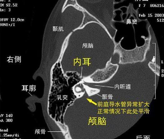 前庭恢复一般要多久怎么治疗有关前庭恢复一般要多久的详细内容