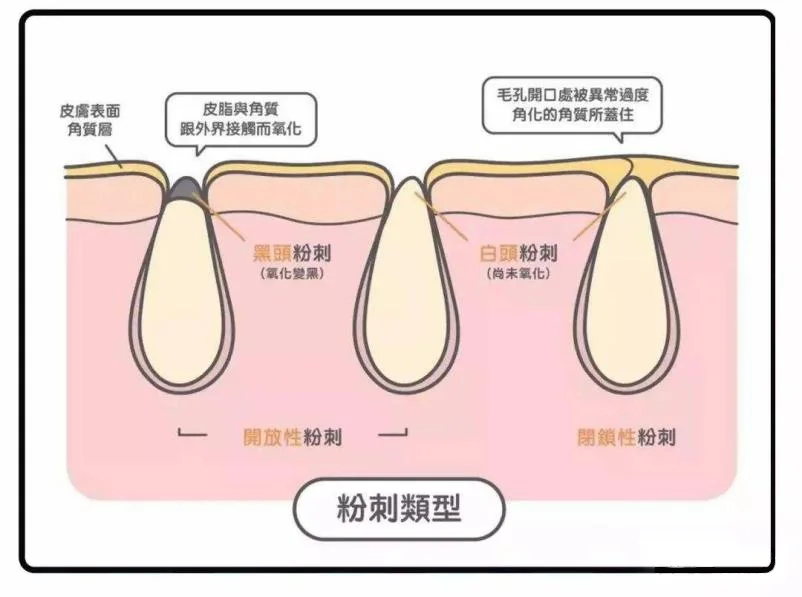 如何去粉刺和黑头粉刺包括如何去粉刺的具体内容