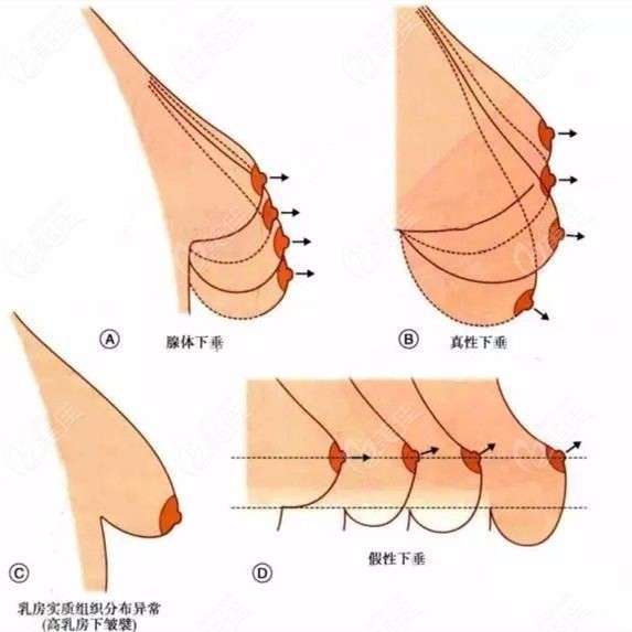 胸为什么会下垂松弛，关于胸为什么会下垂详细情况