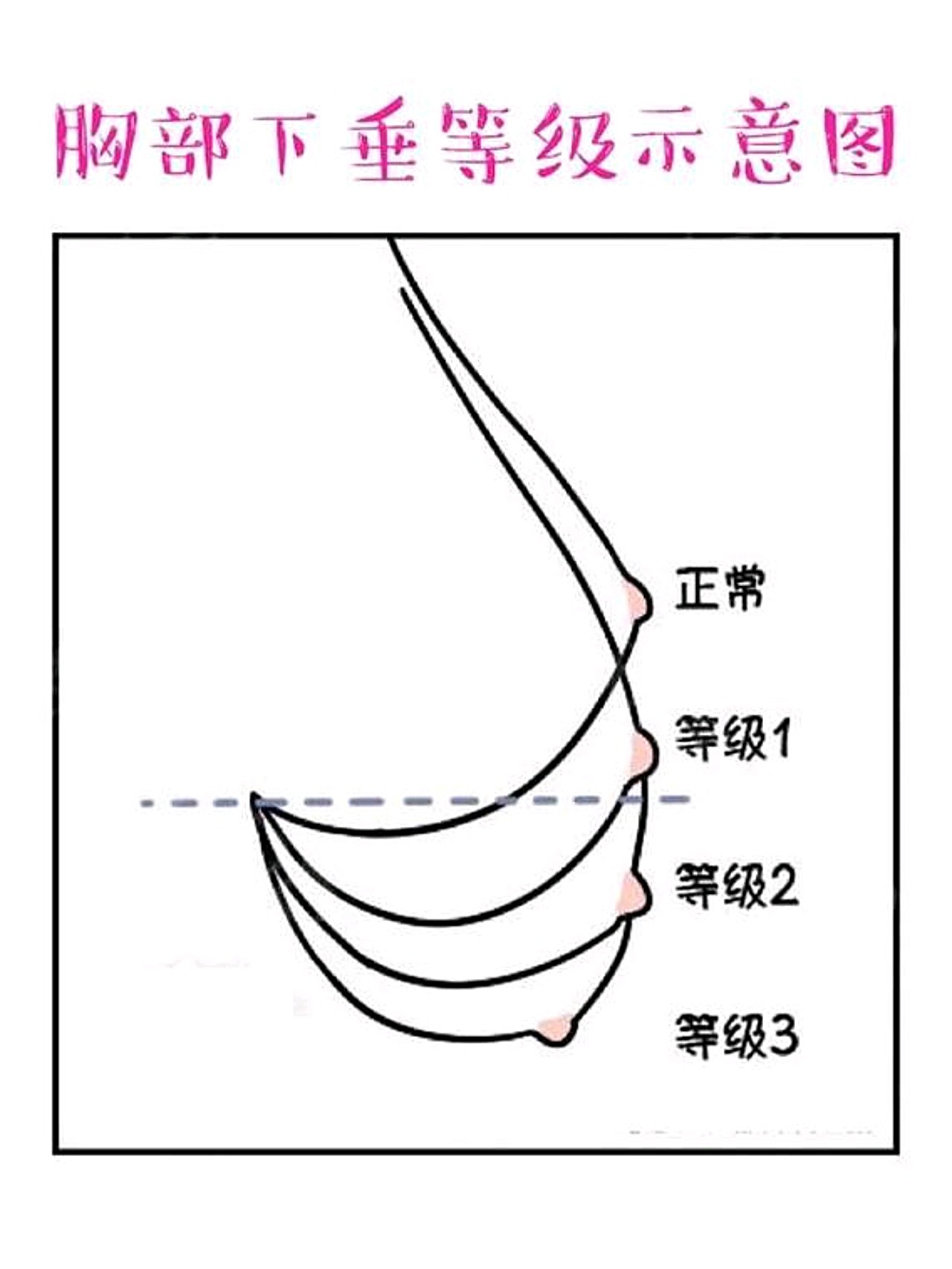 胸为什么会下垂松弛，关于胸为什么会下垂详细情况