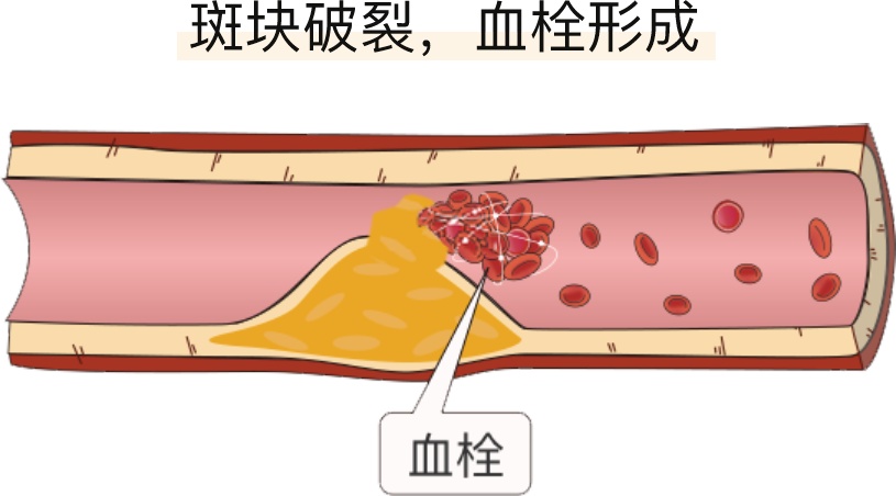 什么叫做血栓形成以及什么叫血栓形成的情况分析