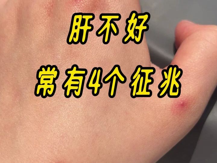 肝不好会有哪些症状男性吃什么药调理以及肝不好会有哪些症状的情况分析