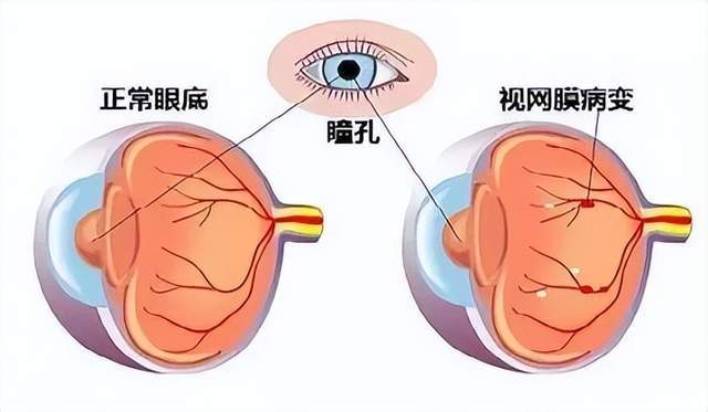 湿性黄斑病变多久会失明包括黄斑病变多久会失明的具体内容