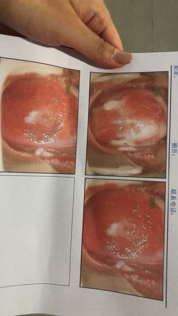 宫颈糜烂是怎么引起的以及宫颈糜烂有哪些症状的情况分析