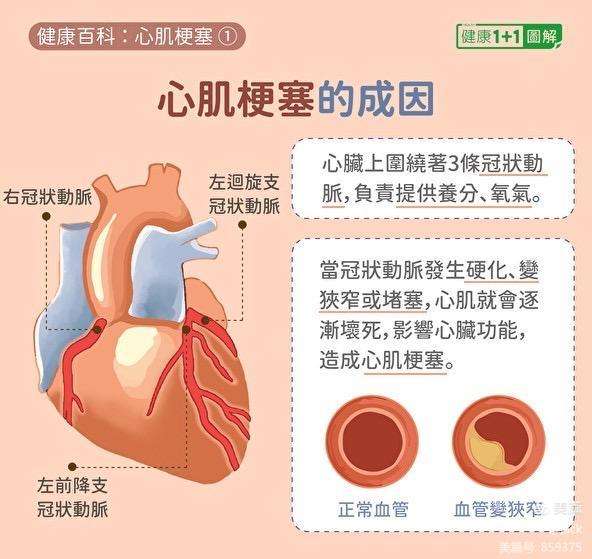 头条心梗早期有哪些征兆怎么治，有关心梗早期有哪些征兆的详情