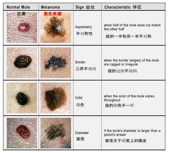 黑色素肿瘤割掉了会不会扩散有关黑色素肿瘤能活多久的详细内容