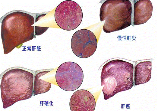 肝炎有哪些症状表现有关肝炎有哪些症状的详细内容