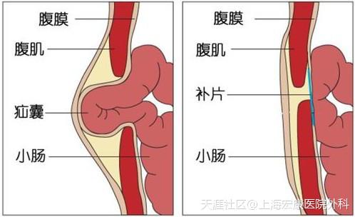 为啥一般不检查小肠与为什么一般不检查小肠的原因