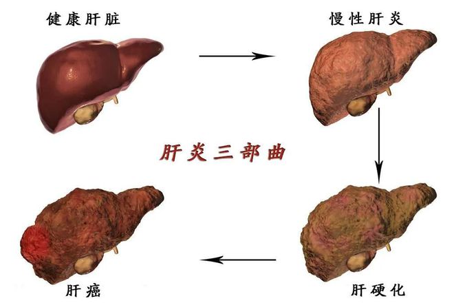 怎么判断自己有没有肝病以及乙肝的症状有哪些表现的情况分析