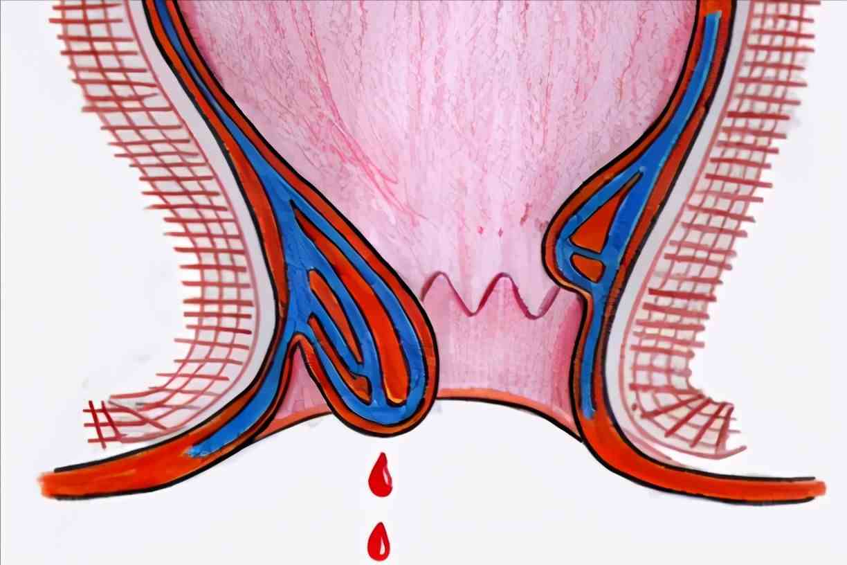 为什么拉屎有血但是不疼包括为什么拉屎有血的具体内容
