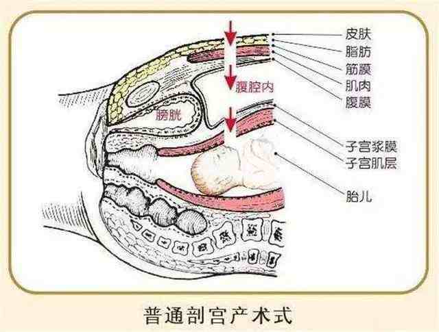 顺产和剖腹产多久可以性生活以及剖腹产多久可以性生活的情况分析