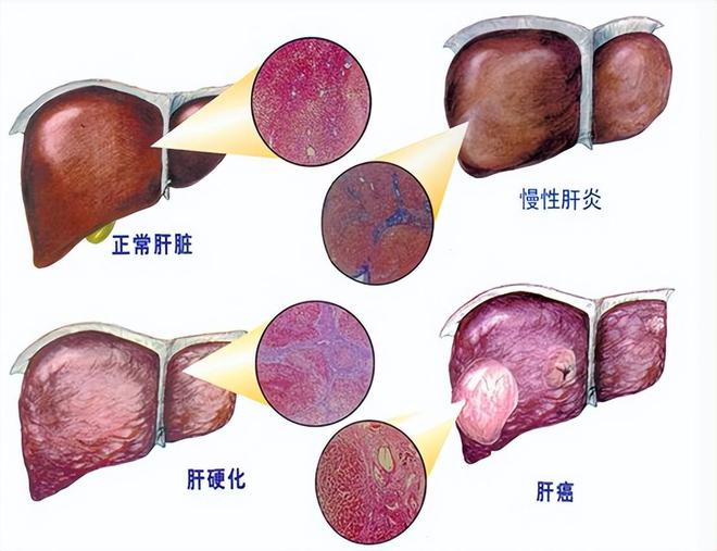 女性肝炎的症状有哪些和肝炎的症状有哪些的详细介绍