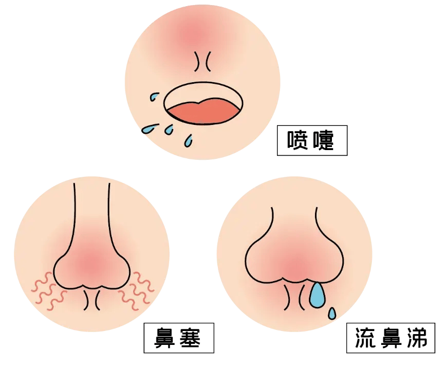 冷空气过敏性鼻炎的症状都有哪些，关于过敏性鼻炎的症状都有哪些详细情况