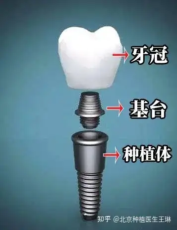 种植牙要多久才能完成有关种植牙要多久的详细内容